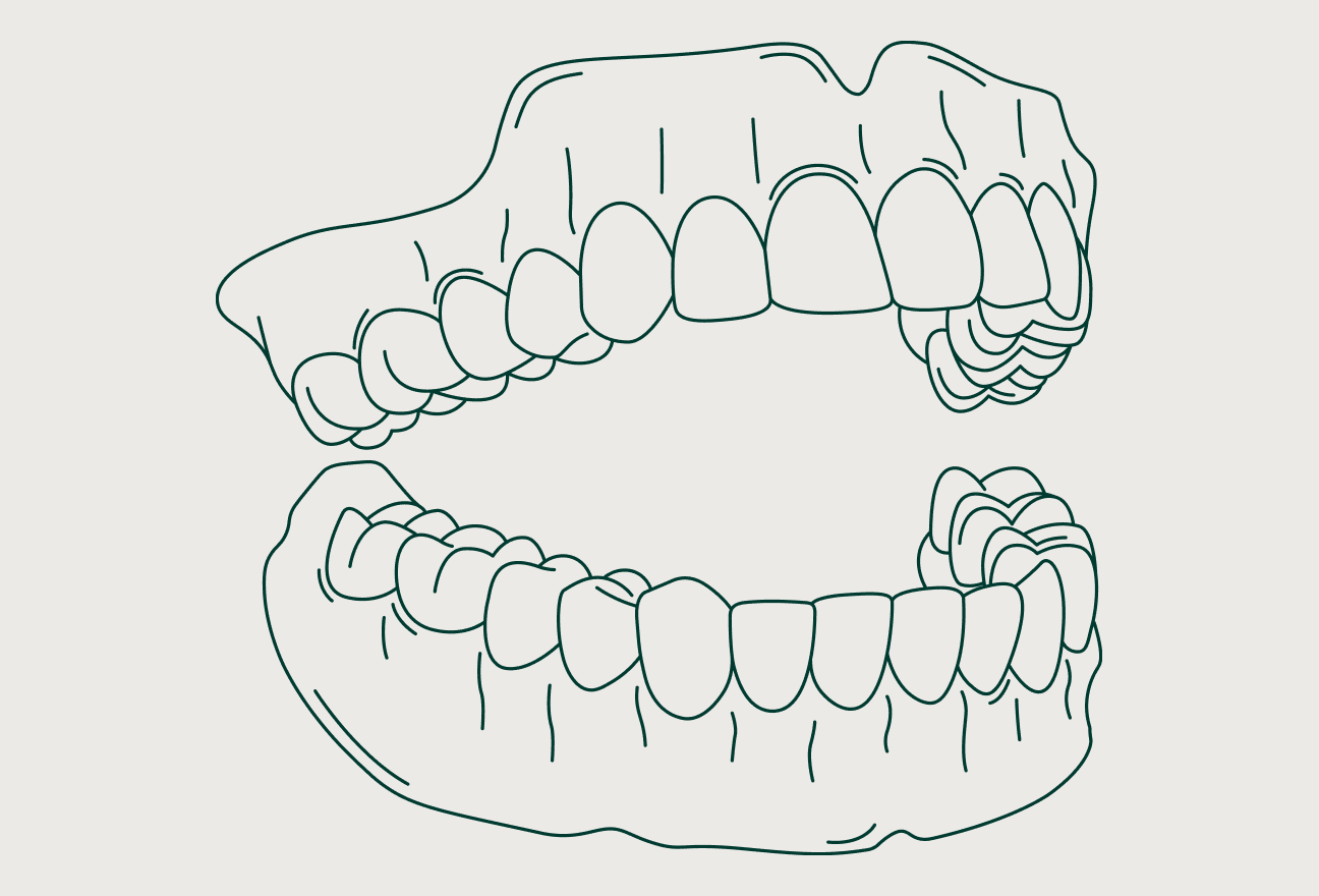 Digital Dentures