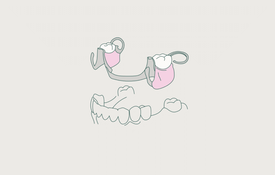 partial dentures