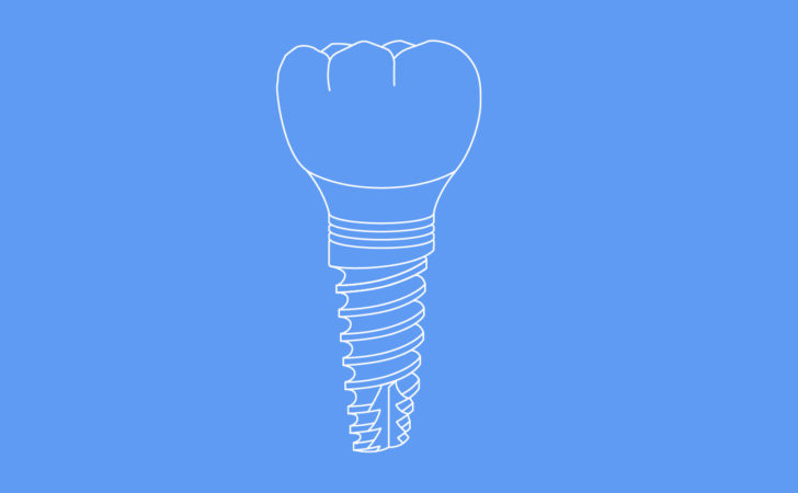 Implant Restorations
