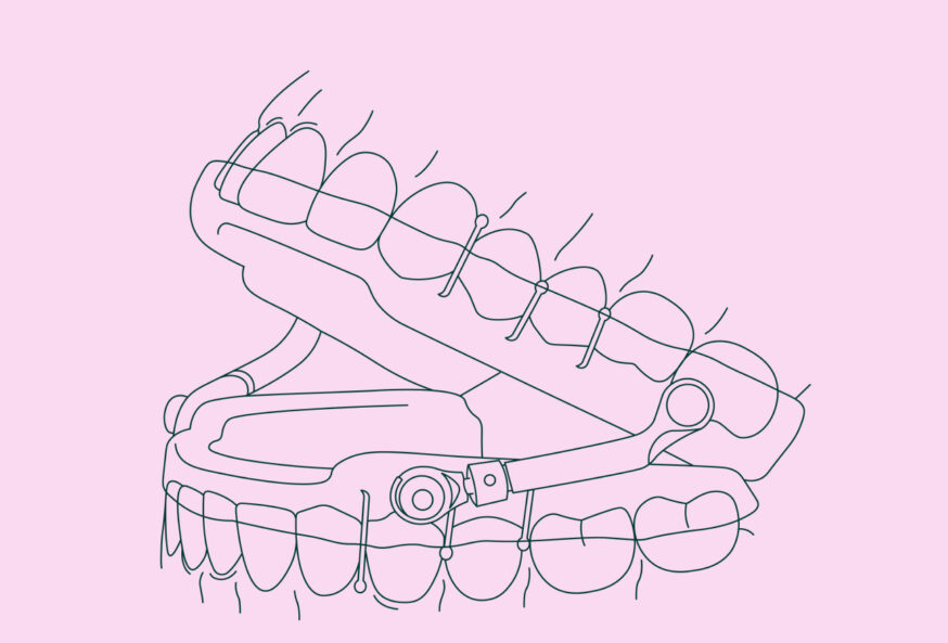 Sleep apnea dental appliance