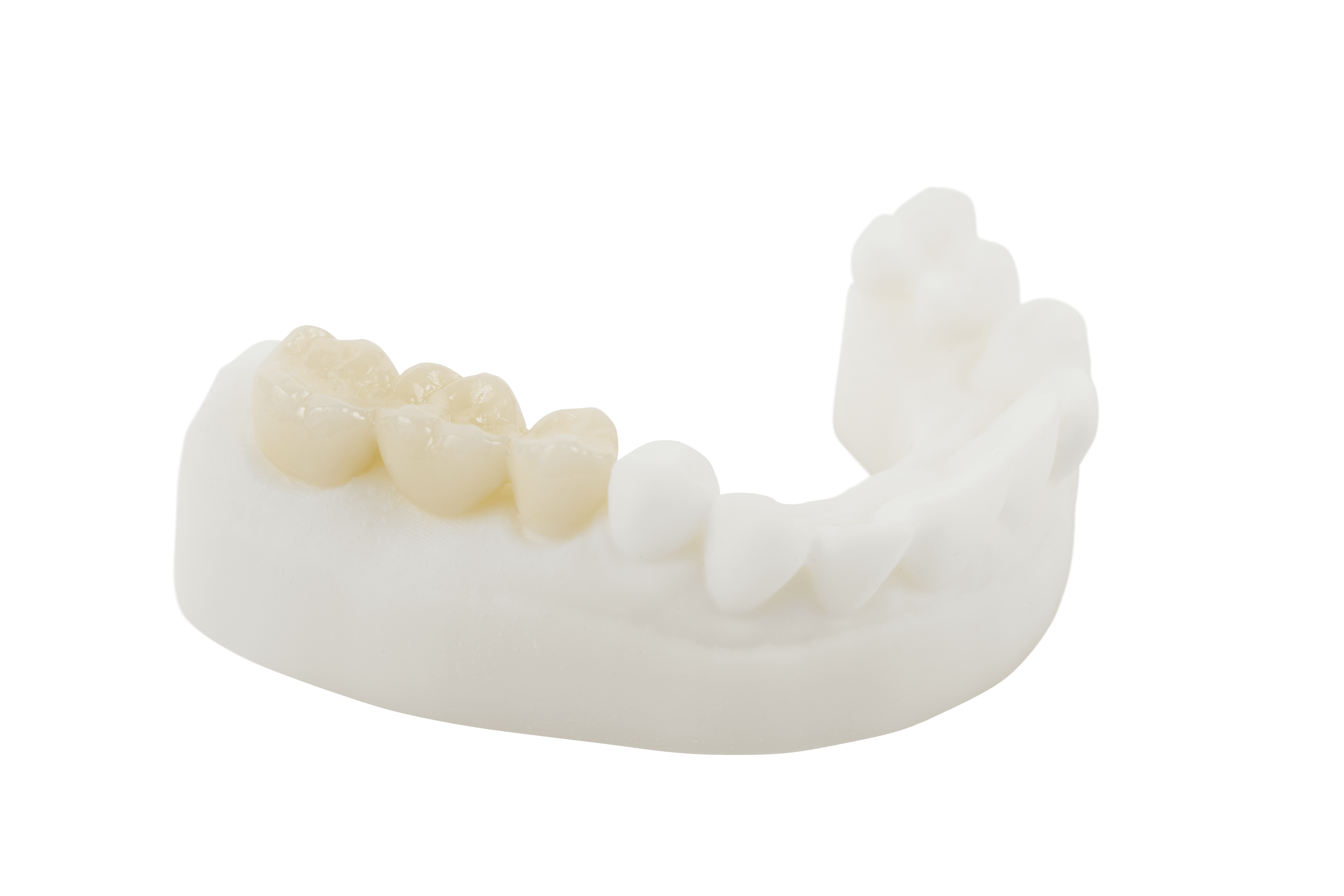 Full indicated use PFZ crowns