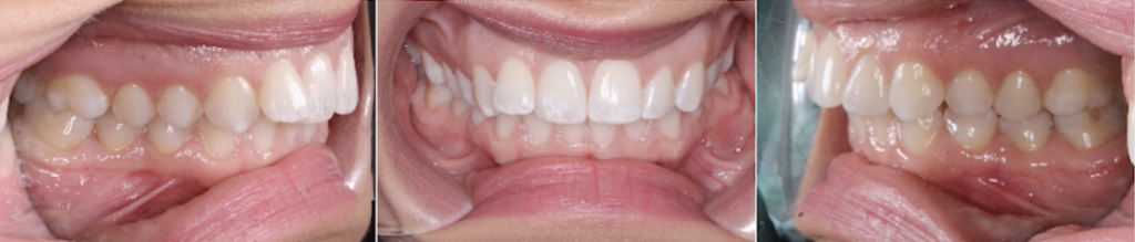 Image of intraoral teeth photography