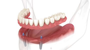 illustration of an implant overdenture