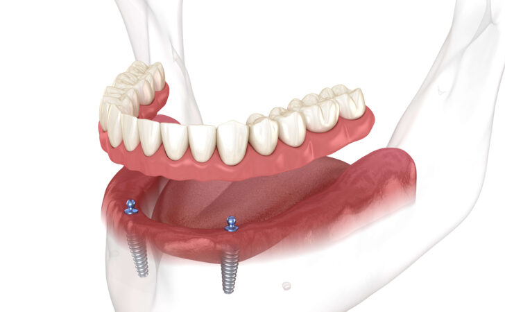 illustration of an implant overdenture