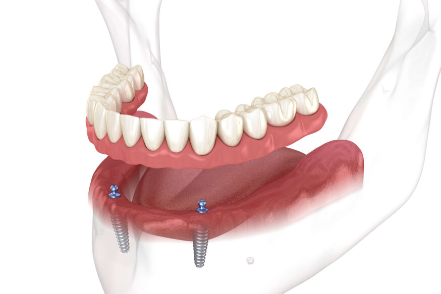 illustration of an implant overdenture