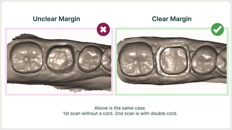 Scan proof of no cord vs double packing cord retraction