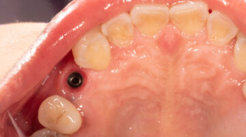 photo or a dental emergence profile