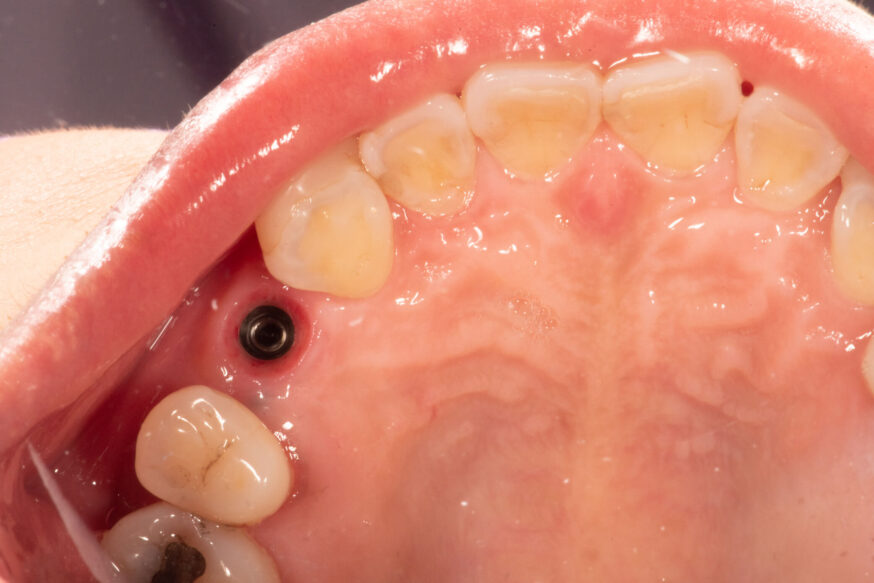 photo or a dental emergence profile