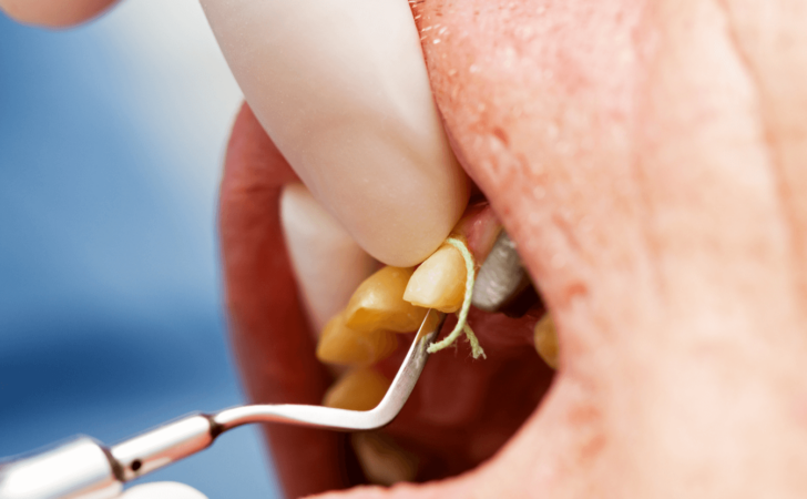 ginigval cord placement