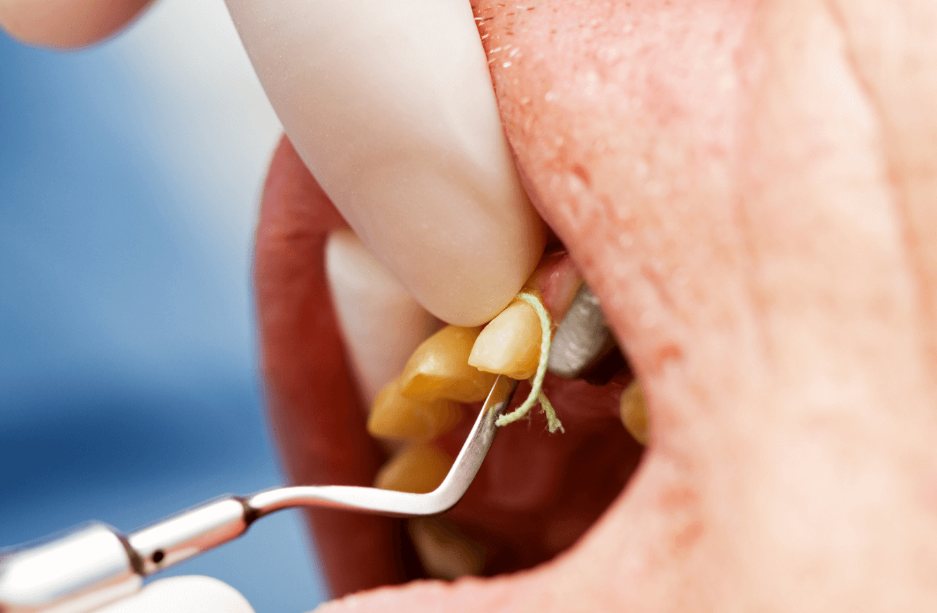 The best gingival retraction techniques [for digital dentistry]