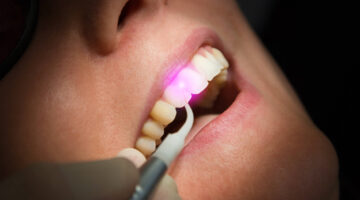 A dental laser inside a patient's mouth