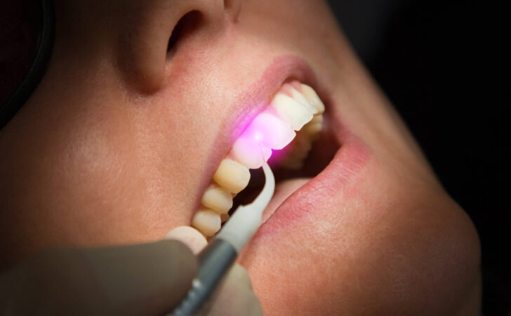 A dental laser inside a patient's mouth