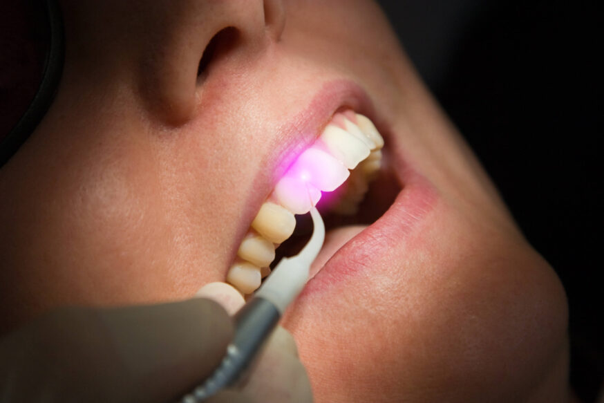 A dental laser inside a patient's mouth