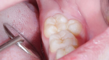 Supernumerary Teeth photo example