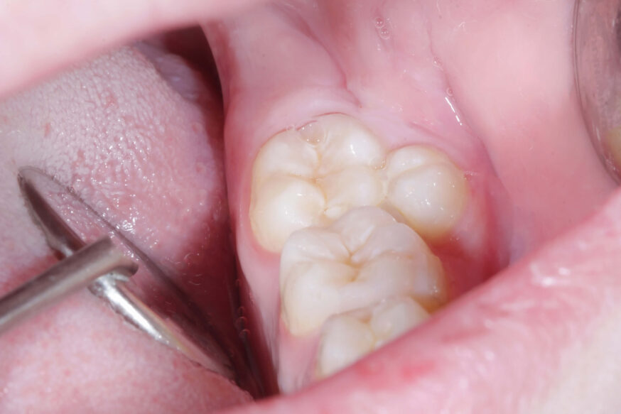 Supernumerary Teeth photo example