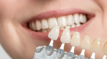 dental teeth whitening