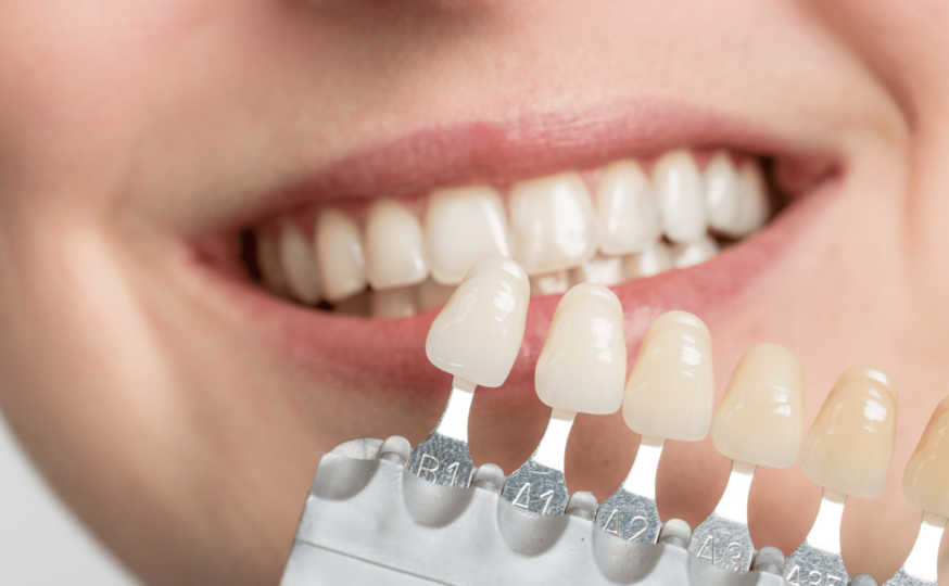 dental teeth whitening