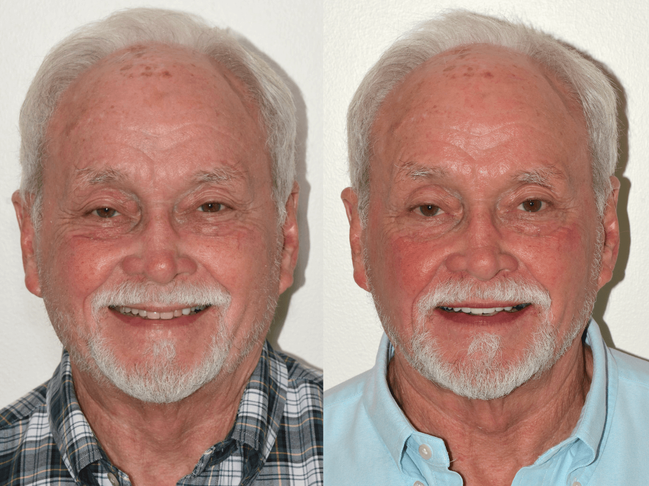 Case Study: Comprehensive Restorative Care with Veneers, Crowns, and Implants