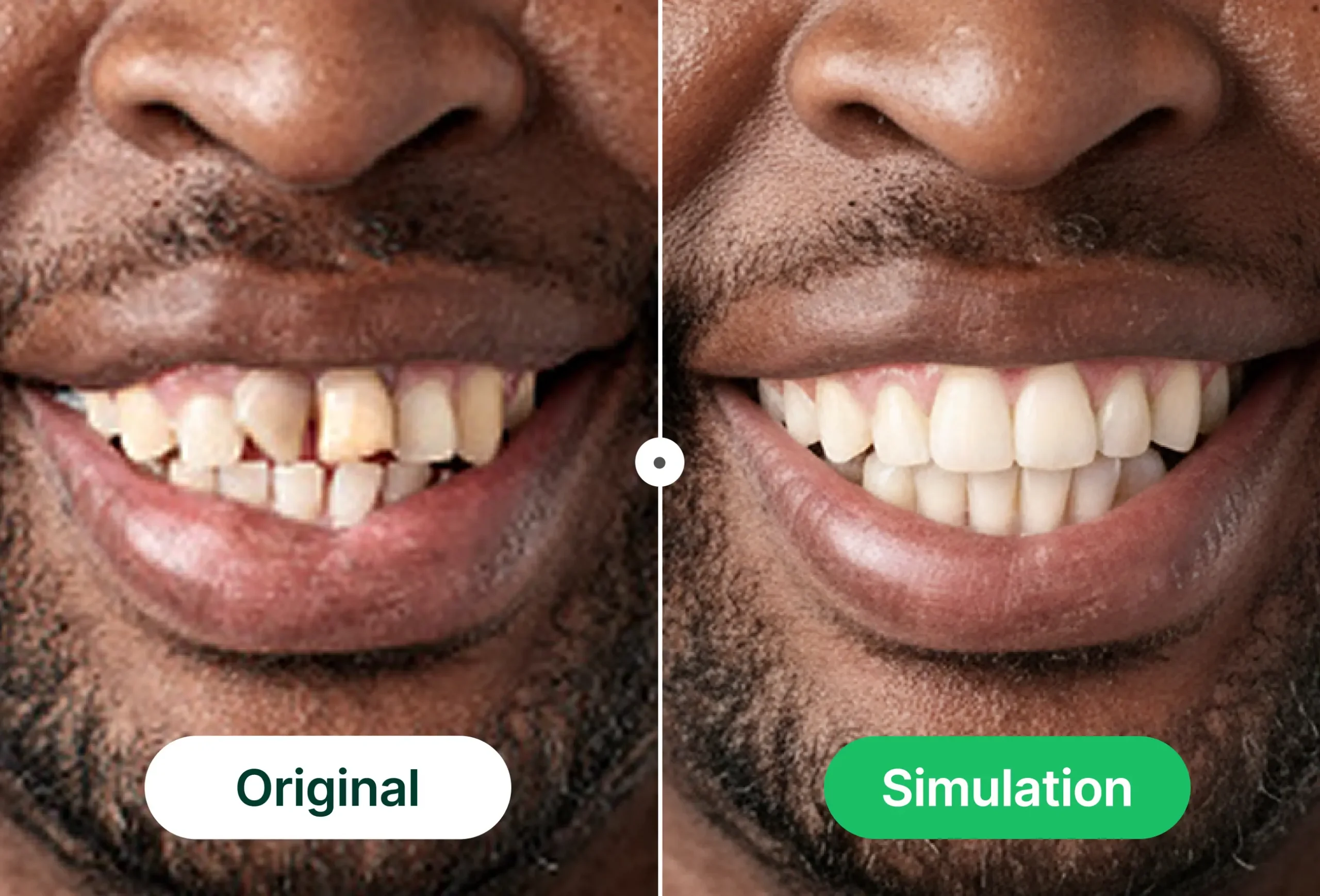 clear aligners