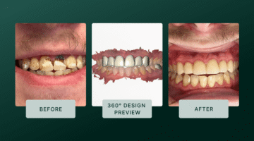 Simplifying Smile Makeovers