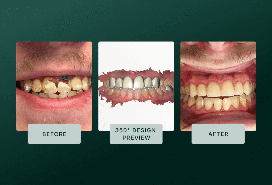 Simplifying Smile Makeovers