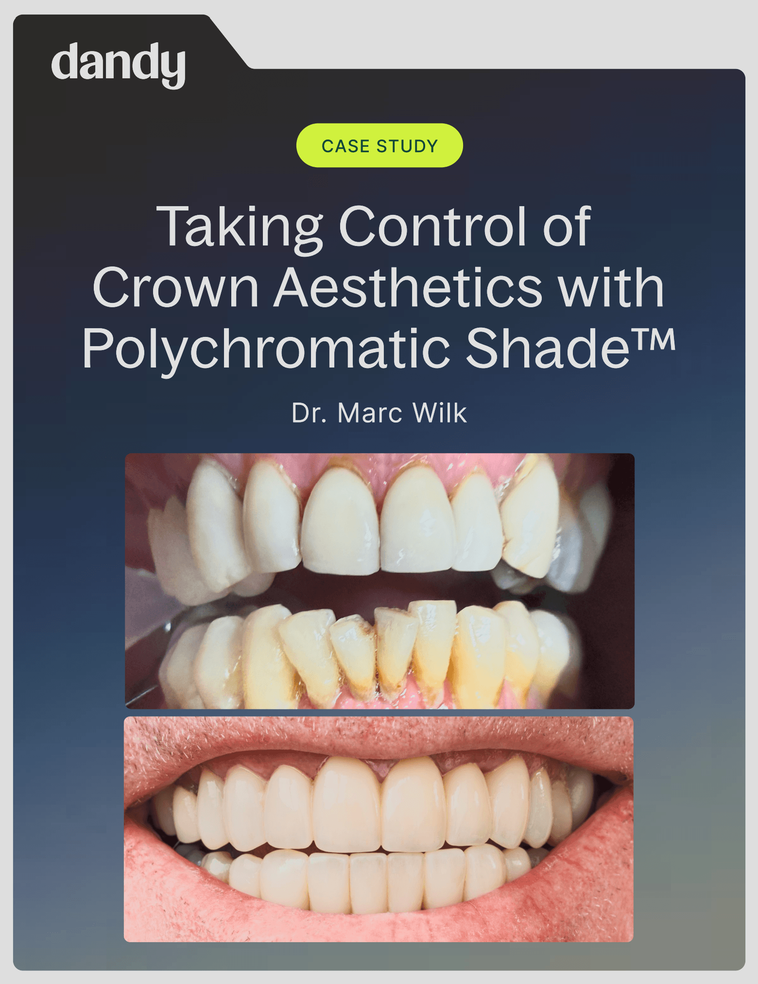 Taking Control of Crown Aesthetics with Polychromatic Shade cover