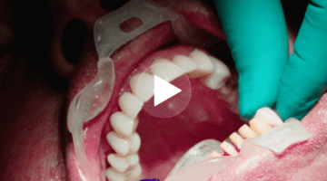 Case Film: Full Digital Workflow of 16-unit Polychromatic Shade™ Case